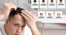 Greft Nedir? 1 Greft Kaç Saç Teli Eder? Greft Hesaplaması Nasıl Yapılır?