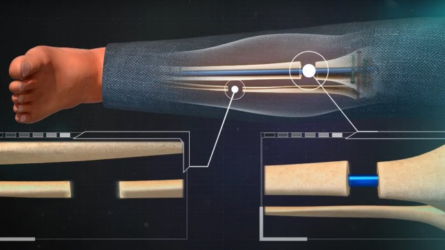 Boy Uzatma Ameliyatı Nedir, Kimlere Yapılır?