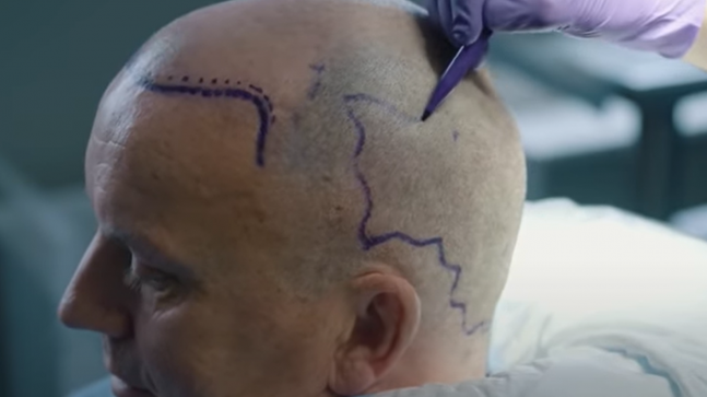 Ankara Saç Ekimi Merkezleri ve Fiyatları 2020