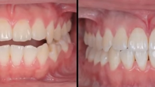 Telsiz Çarpık Diş Düzeltme Nasıl Yapılır?