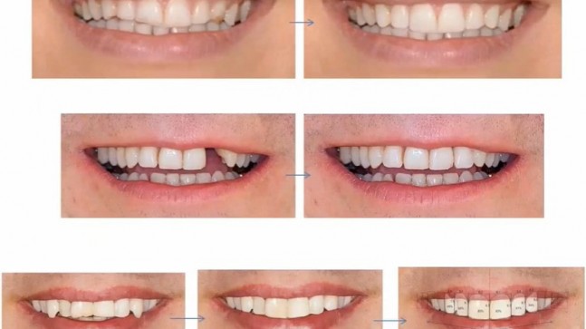 Gülüş Tasarımı Fiyatları 2020