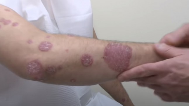 Sedef Hastalığı Çeşitleri ve Tedavisi