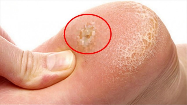 Topuk Dikeni Belirtileri ve Karbonat İle Tedavisi