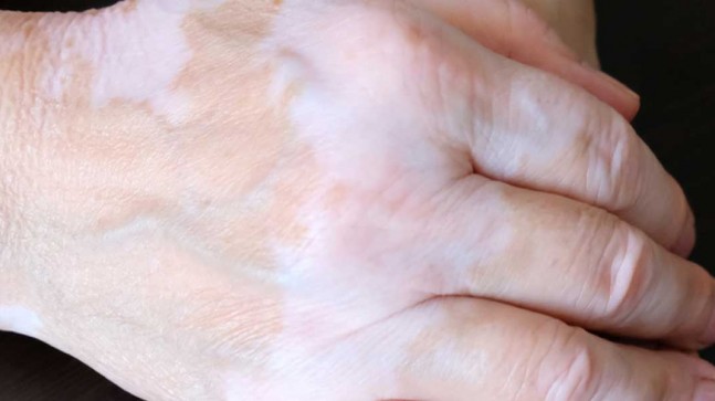 Vitiligo Hastalığı Bitkisel Tedavisi