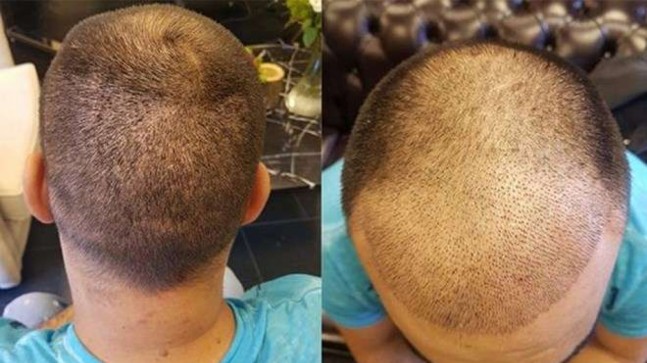 Yazın saç ekimi yapılır mı? Yazın Saç ektirmek zararlı mı? En iyi saç ekimi yapan merkezler ve fiyatları…