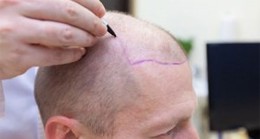 9 Best Hair Transplant Doctors in Turkey and Hair Transplant Cost In Istanbul