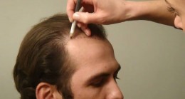How Much Will Hair Transplant Costs Be in Turkey in 2022? Which Are the Best and Most Expensive Hair Transplantation Centers in Turkey?