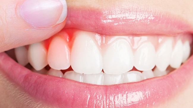 Hatalı Diş Dolgusu Nasıl Anlaşılır? Hatalı Diş Dolgusu Çok Ağrı Yapar Mı?